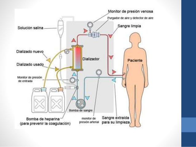 procedimiento de hemodialisis